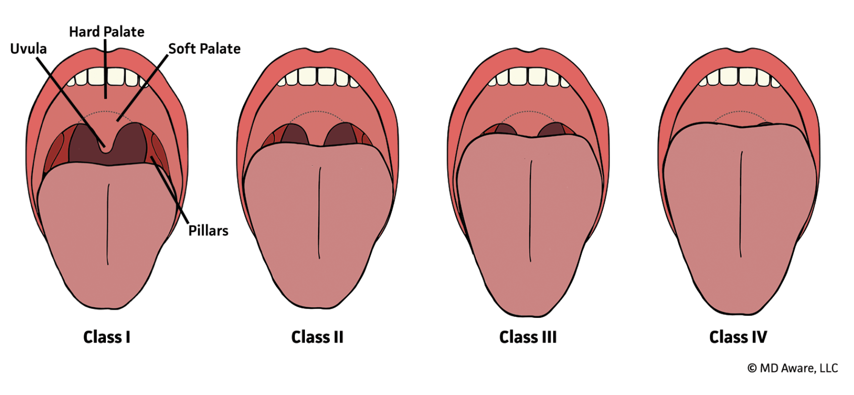 Mallampati classification diagram showing classes I through IV